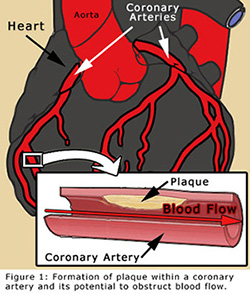 Illustration of heart and plaque building on an artery.